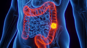 cancers colorectal
